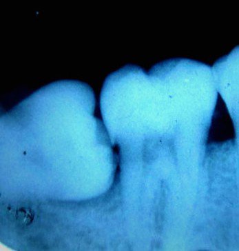 impacted teeth x ray